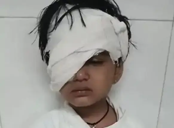 सूरत में 5 साल की बच्ची ने खेल-खेल में चूने की थेली को दांतों से खोलते समय, चूना उड़कर उसकी आंख में चला गया जिसके बाद उसे ऑपरेशन कराना पड़ा।